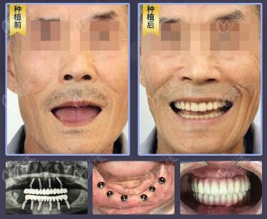 南京华美口腔做种植牙的口碑如何针对微创种植牙技术做评价