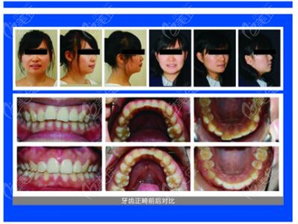 南京鼓楼美奥口腔隐形矫正靠谱吗上牙前突矫正效果值得一看