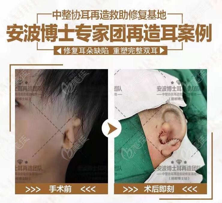 北京安波做的耳再造怎样呢他做过的生物支架再造耳图片可以告诉你