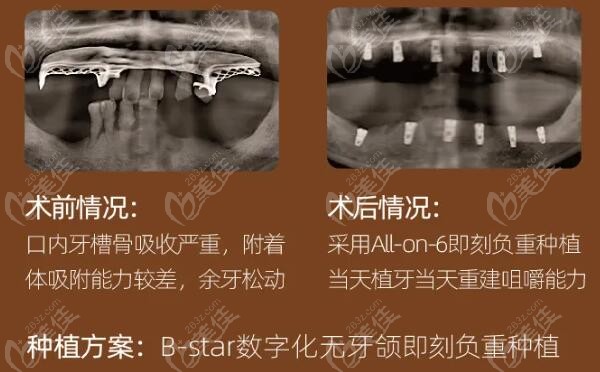 牙齿脱落,经过医生检查后发现大牙牙槽骨吸收很多, 所以需要植骨种植