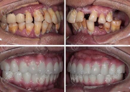 全口all-on-6种植成功前后对比图-病例展示▼ 芜湖嘉邦做一颗种植牙的