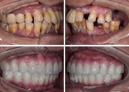 b232g0v0b牙齿拥挤2021-07-15 17:54:50要问芜湖戴牙套,种植牙,补牙
