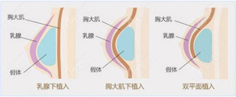 福州丰胸去哪家医院好呀?找这三家做假体隆胸和自体脂肪隆胸准没错呦!