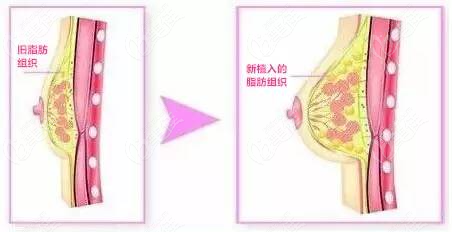福州丰胸去哪家医院好呀?找这三家做假体隆胸和自体脂肪隆胸准没错呦!