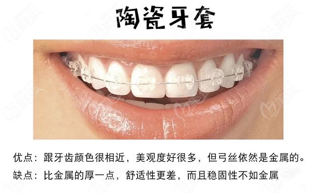 陶瓷半隐形牙齿矫正器的优缺点