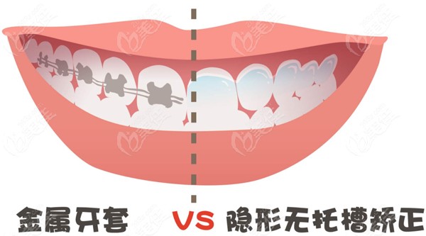 在杭州做牙齿矫正大概要花多少钱舌侧隐形牙套和钢牙套的价格相差多吗