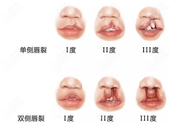 详述上海王艳医生唇腭裂二期修复的费用大概多少钱能报销吗