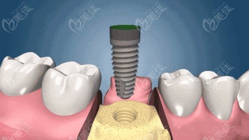第二步:大概三个月的骨愈合后,需要将种植体穿出牙龈,再安装愈合基台