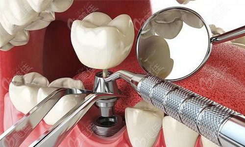 银川艾齿口腔做种植牙的过程步骤三