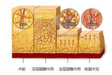 长沙艺星面部吸脂示意图参考