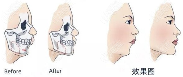 正颌手术解决的是骨性凸嘴,上下颌前突,地包天,双颌前突,偏颌等颌面
