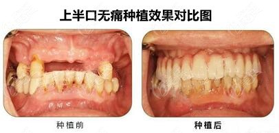 要不看下朱传定医生的即刻种植牙病例图