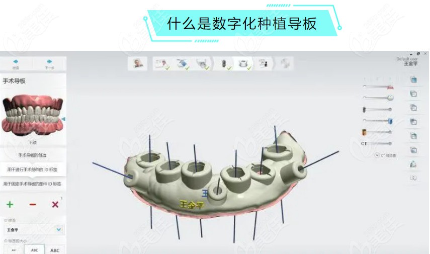 三河燕郊阳光树口腔3d导板种植技术