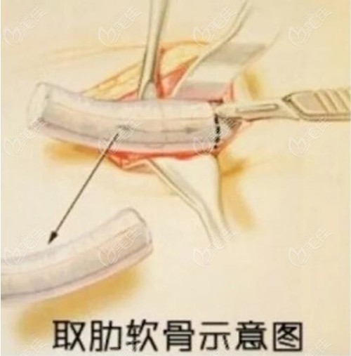 南昌伊丽陈远海医生做隆鼻怎么样据说他做的肋软骨隆鼻很可哦