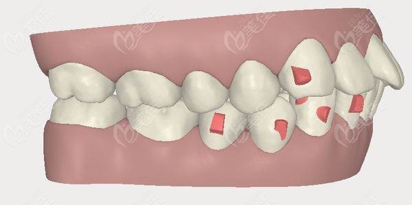 上下颌牙槽骨突出,通过拔牙矫正会让凸出的牙槽骨下去