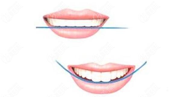 在为顾客设计方案的时候,结合"dsd微笑线"设计,后期不仅牙齿整齐,脸型