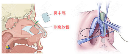 问赣州华美方贤成医生做鼻子技术好不好不如来看他近期做得肋骨鼻综合