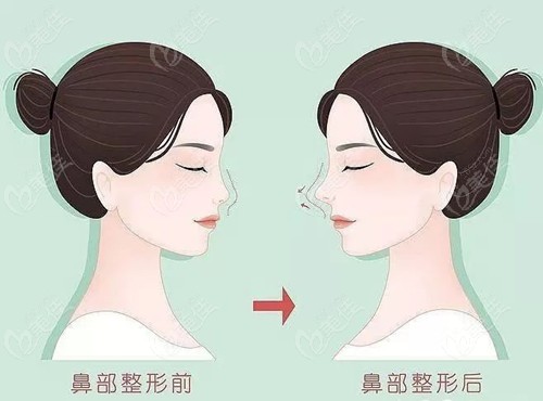 南昌佳美张效恩院长做软骨隆鼻好不好呢从简介中得知这是他比较擅长的