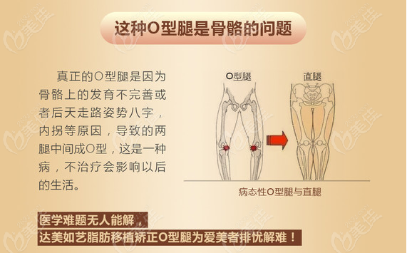 快看国内o型腿矫正好的正规医院排名及医生价格新鲜出炉啦