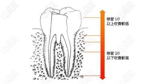 看完深圳牙科根管治疗价格后,就知道治疗一颗牙要多少