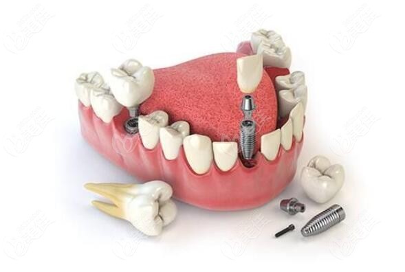 种植牙需要注意哪些坑?教你如何种到高性价比的牙齿