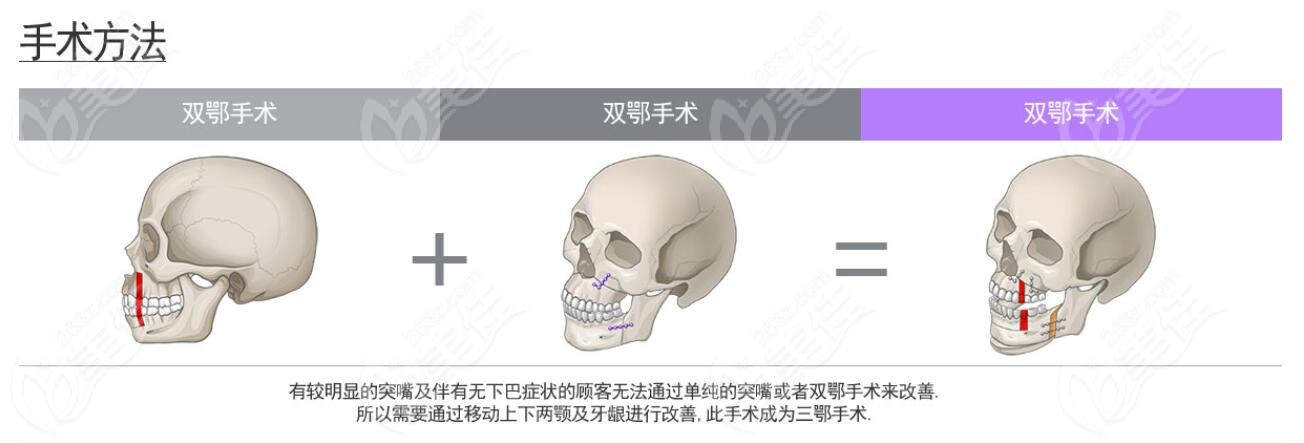 听说会比韩国双鄂手术收费便宜很多