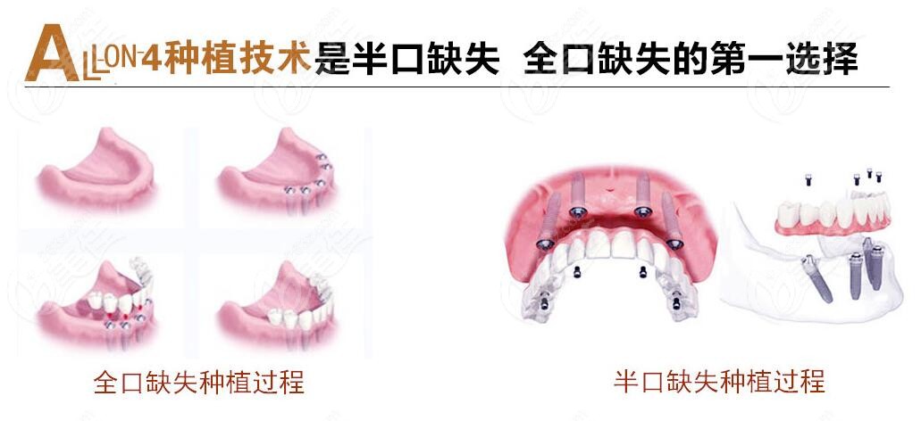 合肥天鹅湖口腔种植牙技术咋样网传周健医生擅长做全口allon4种植