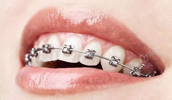 郑州正畸医生排名这几个医生给龅牙做金属牙套矫正不错