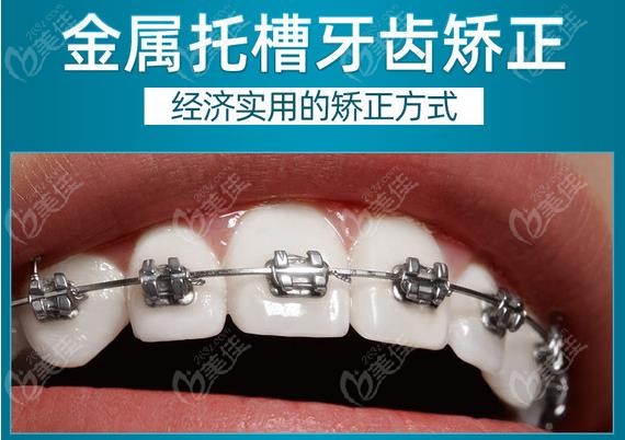 来看郑州植得口腔医院矫正牙齿多少钱,正畸牙套种类多