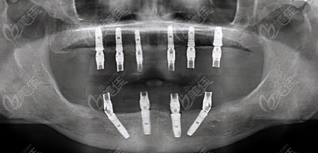 郑老师满口种植牙ct照片