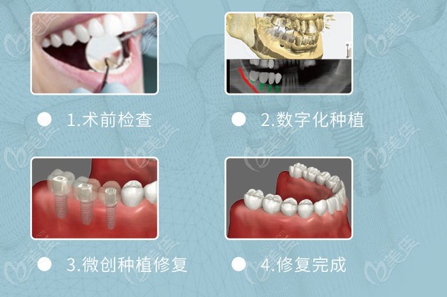 杭州六月微笑口腔种植牙流程