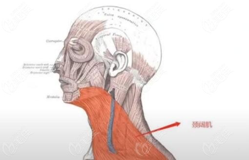 下颌缘提升针作用于颈阔肌
