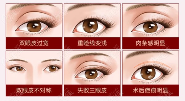 双眼皮失败的八种症状