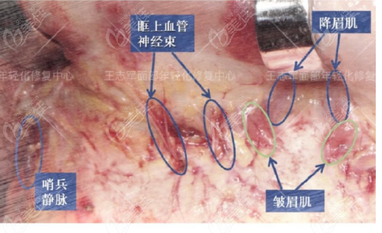 王志军医生做拉皮手术怎么样用我做面部大拉皮术后半年心得为你解答