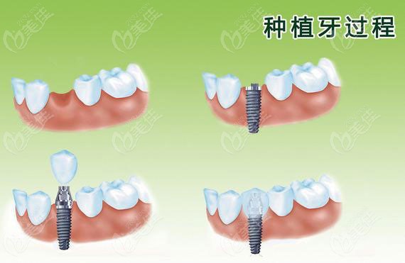 鹰潭牙科医院收费价目表中不就有种植牙及牙齿矫正等费用吗