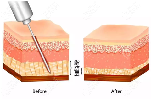 哈尔滨超龙做大腿吸脂怎么样呢,看他家做水动力抽脂的