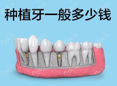 一览深圳龙岗口腔种植牙价格表你知道龙岗种植牙哪家牙科好吗