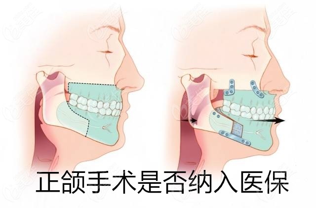 正颌手术是否纳入医保北京上海等省份正颌费用可以报销多少钱