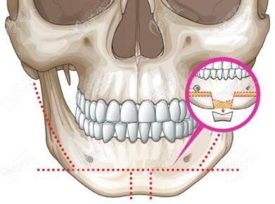 求下巴t型截骨手术过程图解和原理,还想知道它有啥后遗症!