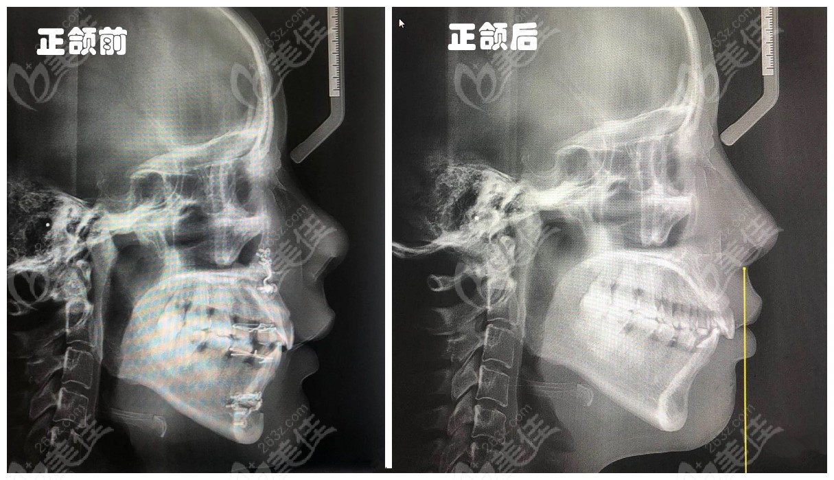 做正颌手术的顾客前后对比图