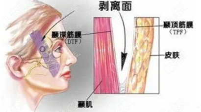 埋没导引面部悬吊术是什么它和埋线提升哪个好区别是啥