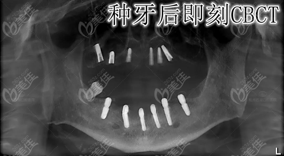 薛先生自述在杭州西湖口腔医院做完aiion6全口即刻种植牙的感受