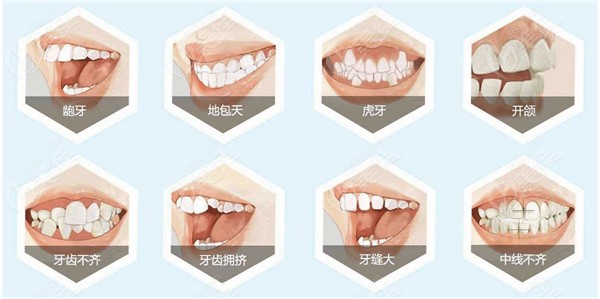 牙齿错颌畸形的种类
