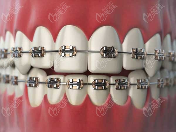 在深圳做牙齿矫正大概要花费多少钱其价格与牙套的类型有关