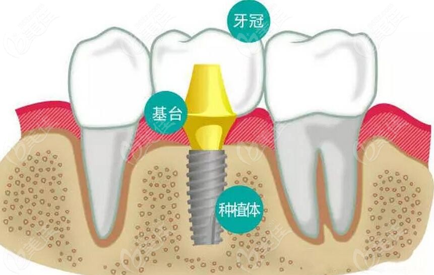 简单介绍下分段种植牙也叫两段式种植牙,简单来说就是种植体基台,植