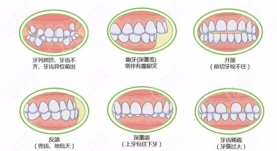 paoo植骨手术会不会影响整牙牙槽骨薄且想正畸的牙友必看