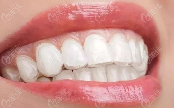 造成牙齿不齐的原因有哪些那固定和隐形矫正的区别大不