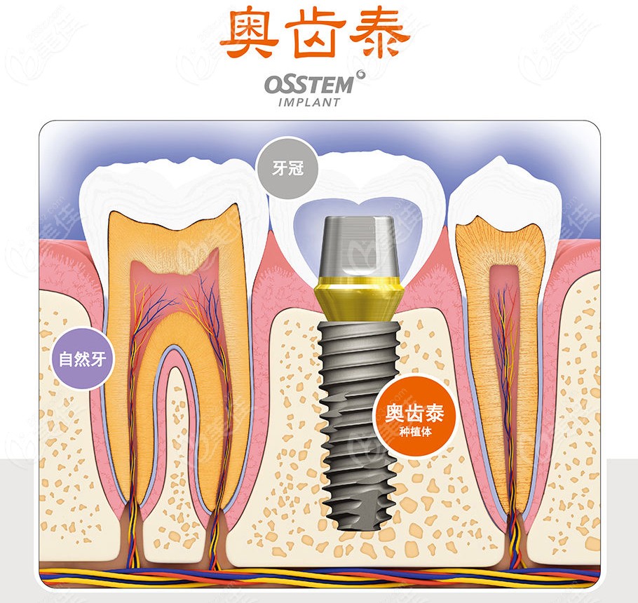 奥齿泰osstem种植牙的生物相容性较好,表面是由ha粉末的rbm组成的,也