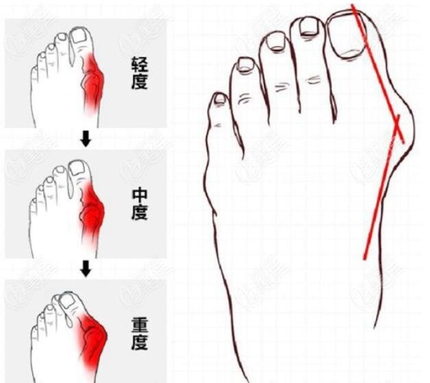 大脚骨程度划分示意图