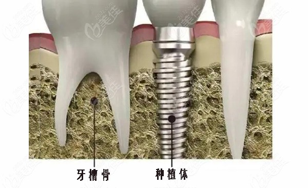 onlay植骨和inlay的区别可从植骨的难度及种牙牙槽骨的条件说起